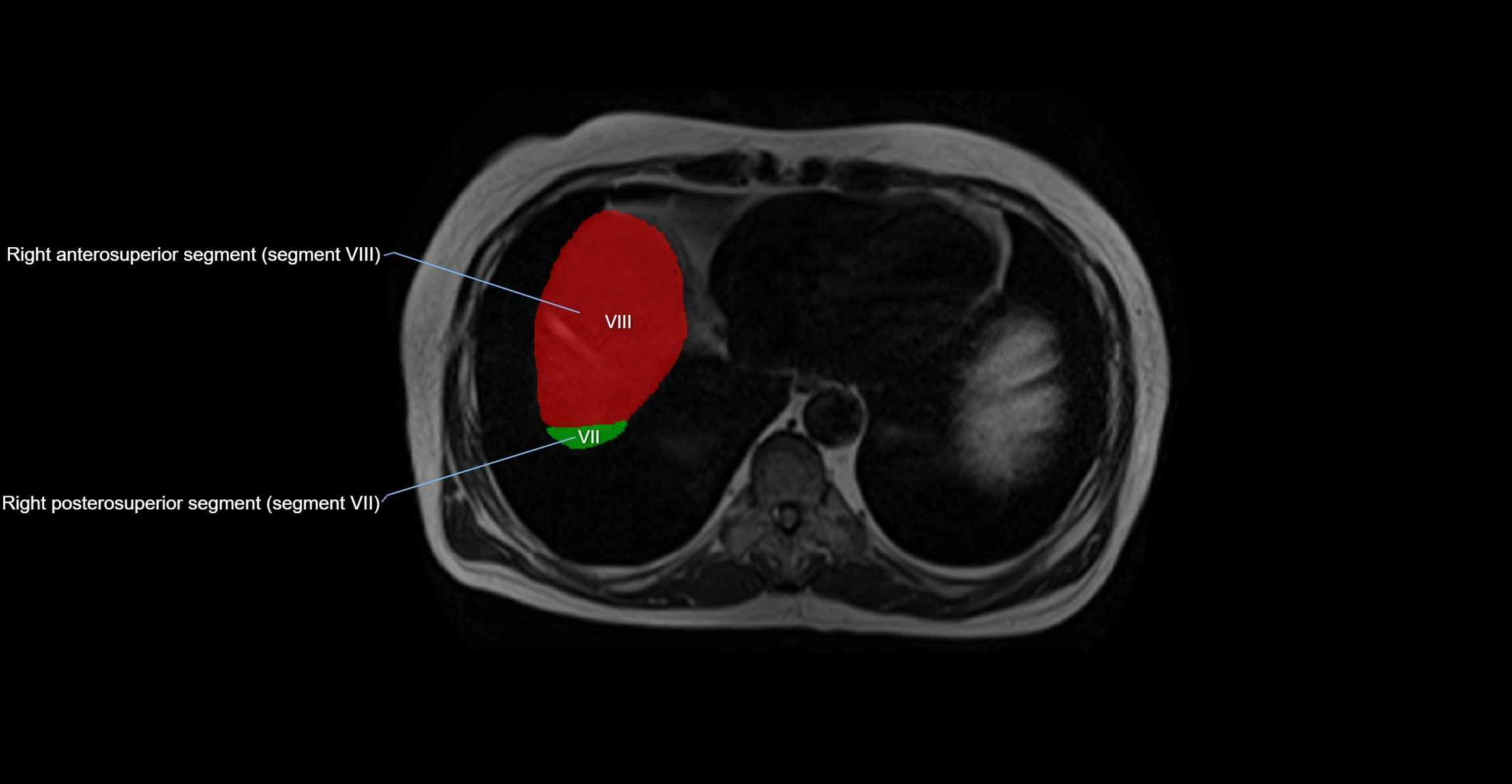 MRI  liver segments anatomy axial cross sectional 3T radiology  image-img-00001-00003.webp